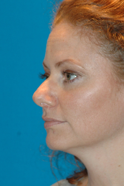 Chin Augmentation, Rhinoplasty Before