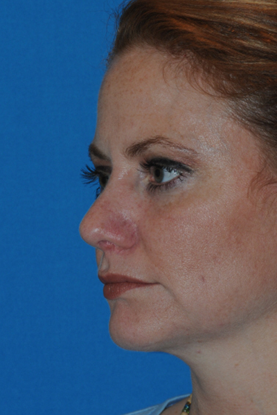 Chin Augmentation, Rhinoplasty After