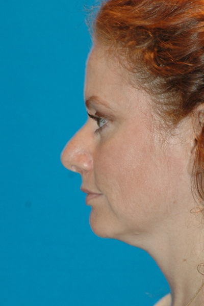 Chin Augmentation, Rhinoplasty Before