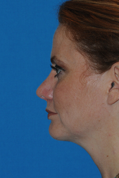 Chin Augmentation, Rhinoplasty After