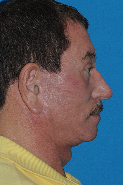 Lower Blepharoplasty, Browlift, Facelift, Fat Transfer After Lower Blepharoplasty, Browlift, Facelift, Fat Transfer After