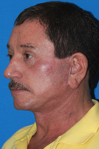 Lower Blepharoplasty, Browlift, Facelift, Fat Transfer After Lower Blepharoplasty, Browlift, Facelift, Fat Transfer After