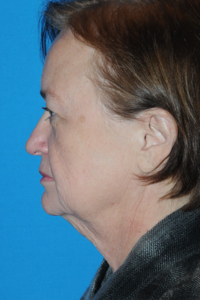 Facelift, Browlift, Upper and Lower Blepharoplasty, Fat Transfer Before
