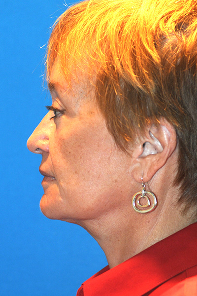 Facelift, Browlift, Upper and Lower Blepharoplasty, Fat Transfer After Facelift, Browlift, Upper and Lower Blepharoplasty, Fat Transfer After