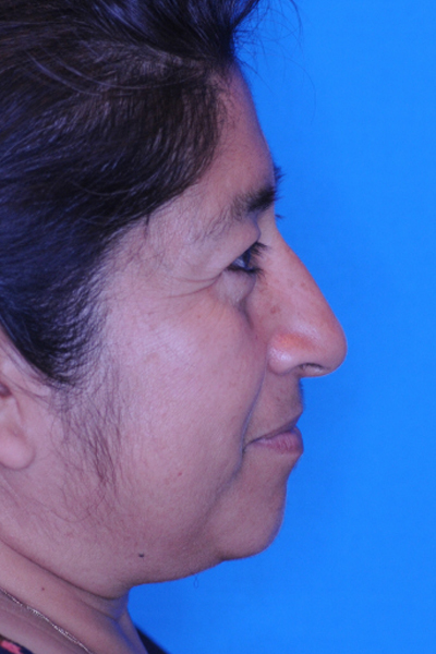 Lower Blepharoplasty After