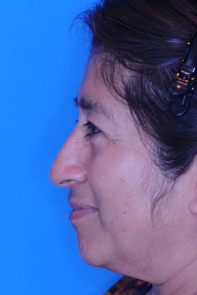 After Eyelid Lift