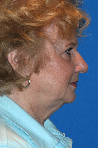 Facelift Before