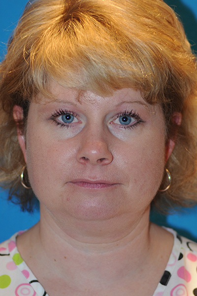 Chin Augmentation, Facelift Before Chin Augmentation, Facelift Before