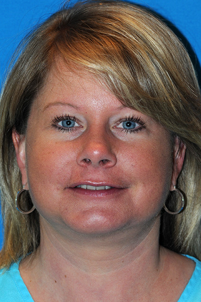 Chin Augmentation, Facelift After Chin Augmentation, Facelift After