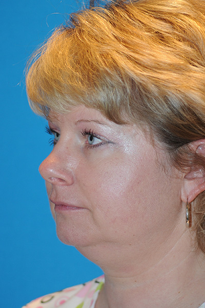 Chin Augmentation, Facelift Before
