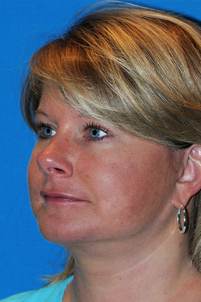 Chin Augmentation, Facelift After Chin Augmentation, Facelift After