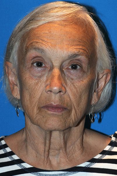 Before Facelift