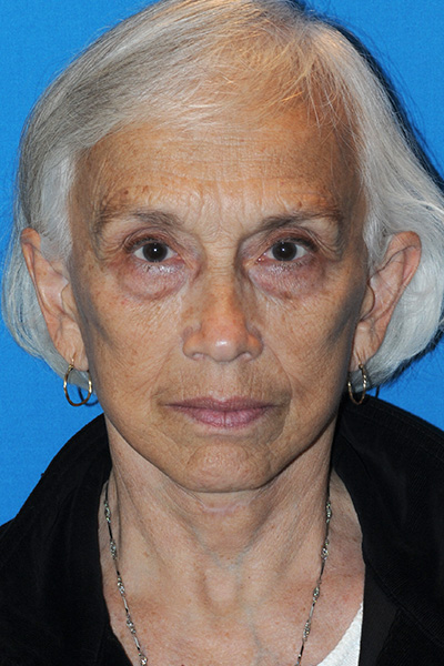 After Facelift