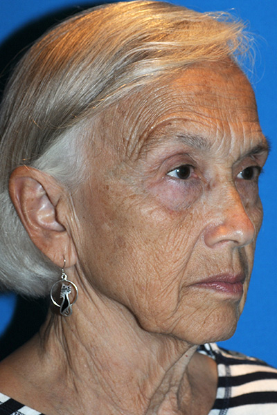 Before Facelift