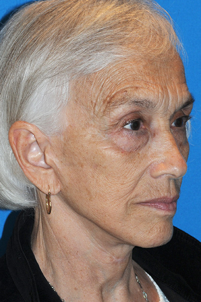 After Facelift