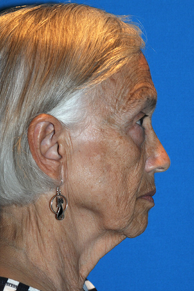 Facelift Before