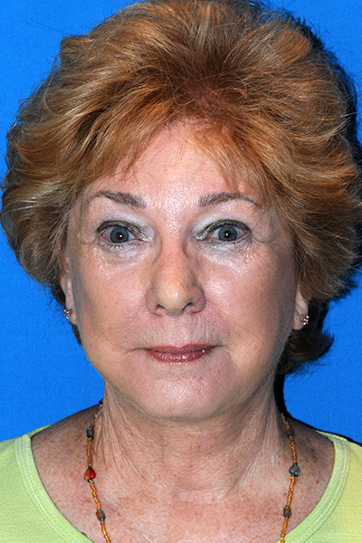 Revision Facelift, Rhinoplasty After Revision Facelift, Rhinoplasty After
