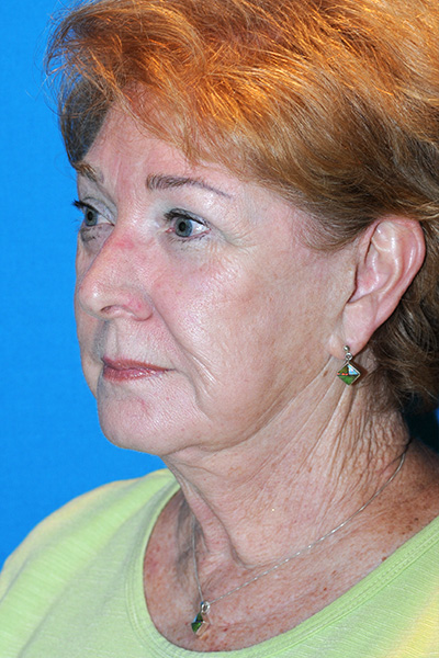 Revision Facelift, Rhinoplasty Before Revision Facelift, Rhinoplasty Before