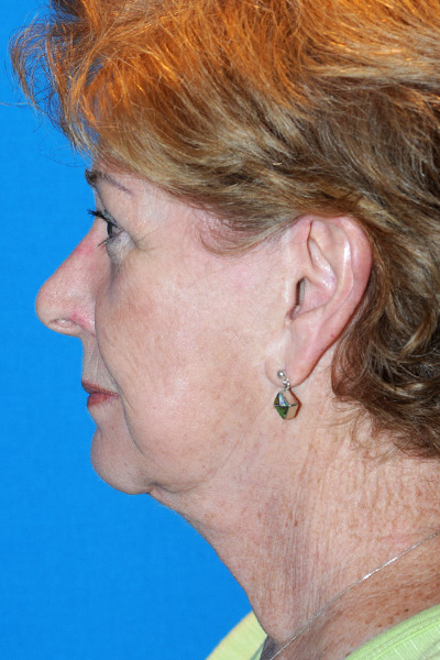 Revision Facelift, Rhinoplasty Before