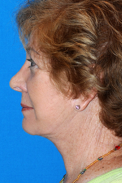 Revision Facelift, Rhinoplasty After