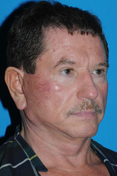 Lower Blepharoplasty, Browlift, Facelift, Fat Transfer Before Lower Blepharoplasty, Browlift, Facelift, Fat Transfer Before