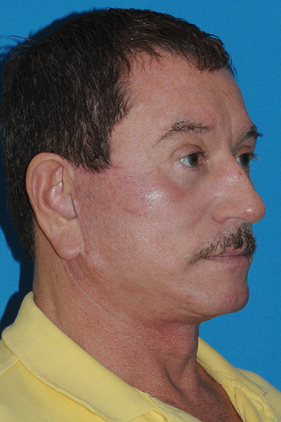 Lower Blepharoplasty, Browlift, Facelift, Fat Transfer After Lower Blepharoplasty, Browlift, Facelift, Fat Transfer After