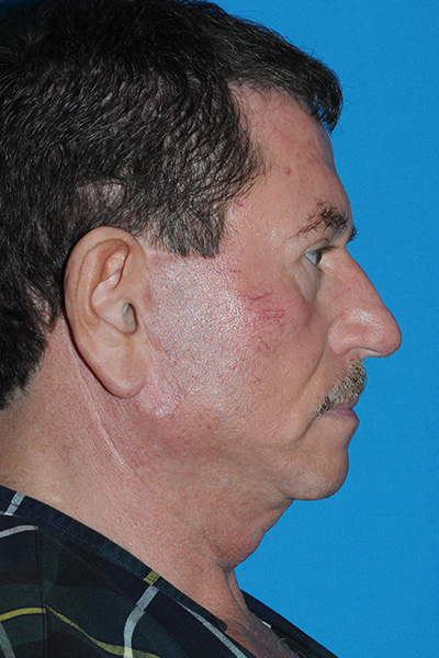 Lower Blepharoplasty, Browlift, Facelift, Fat Transfer Before Lower Blepharoplasty, Browlift, Facelift, Fat Transfer Before
