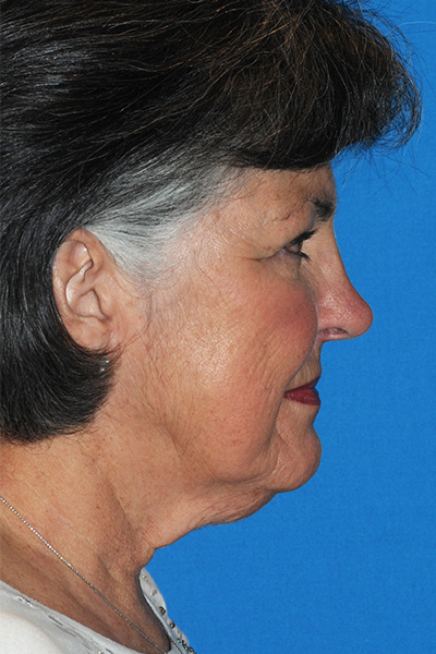 Upper Blepharoplasty, Facelift Before