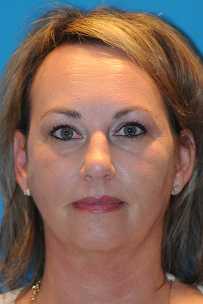 Chin Augmentation, Facelift, Rhinoplasty Before Chin Augmentation, Facelift, Rhinoplasty Before