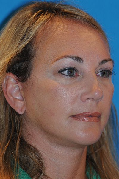 Chin Augmentation, Facelift, Rhinoplasty After Chin Augmentation, Facelift, Rhinoplasty After