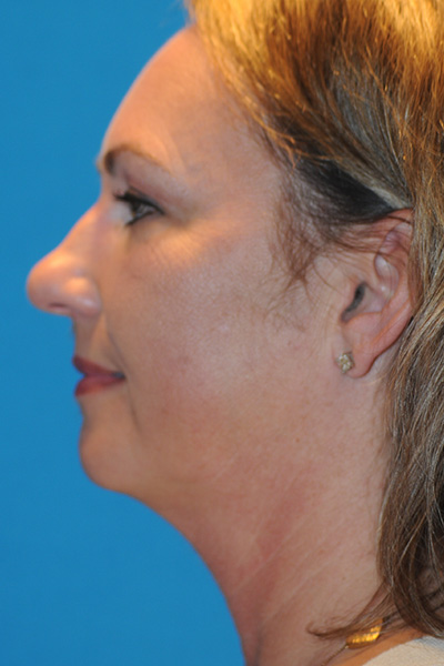 Chin Augmentation, Facelift, Rhinoplasty Before Chin Augmentation, Facelift, Rhinoplasty Before