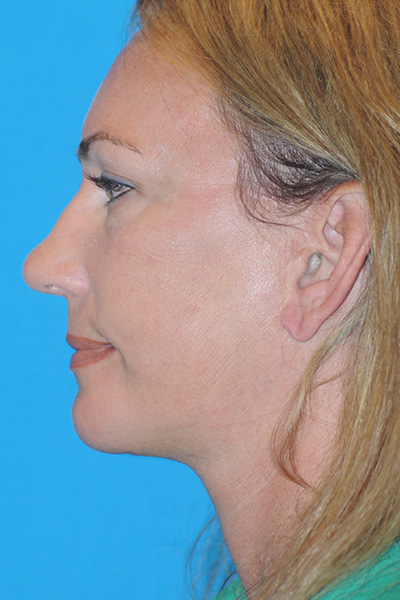 Chin Augmentation, Facelift, Rhinoplasty After Chin Augmentation, Facelift, Rhinoplasty After