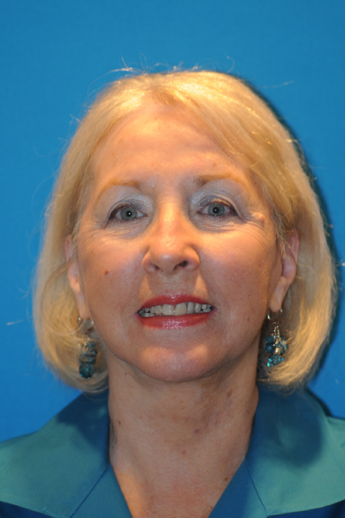 After Facelift