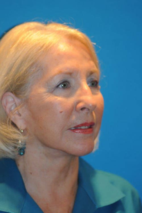 After Facelift