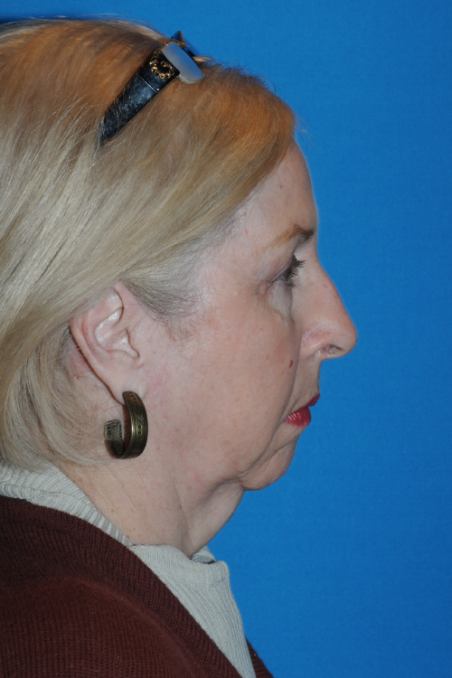 Before Facelift