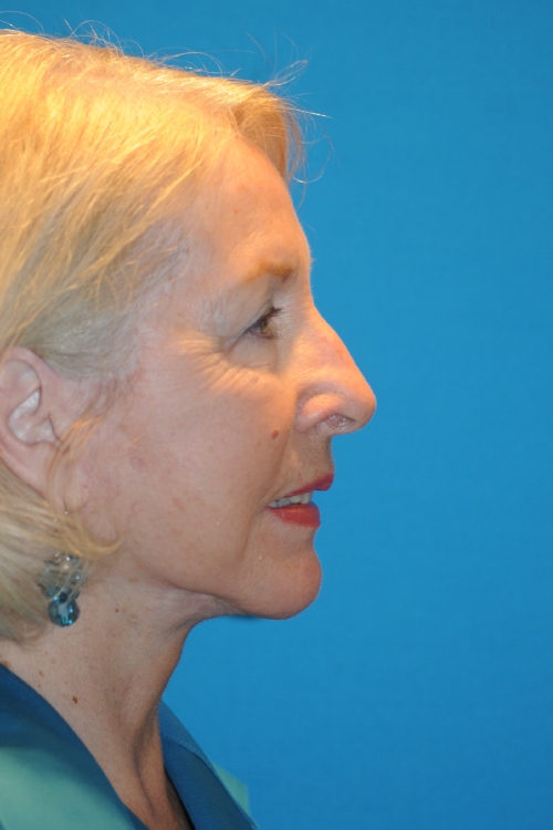 After Facelift