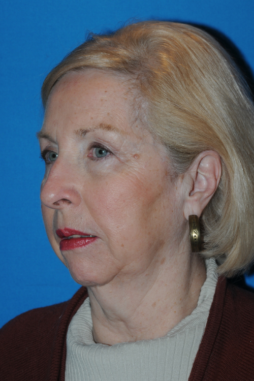 Before Facelift