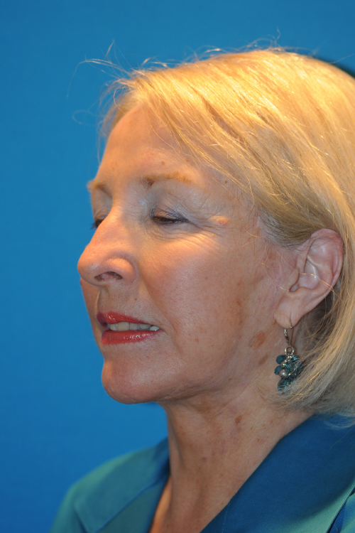 After Facelift