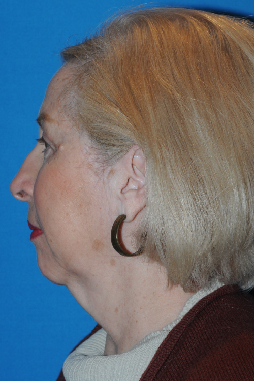 Before Facelift