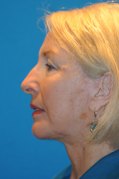 After Facelift