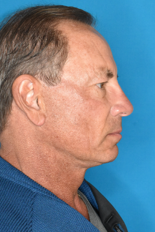 After Facelift