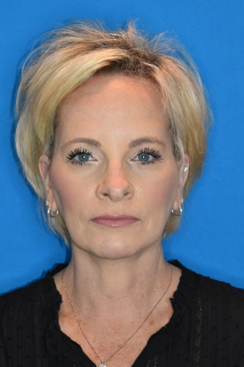 After Facelift