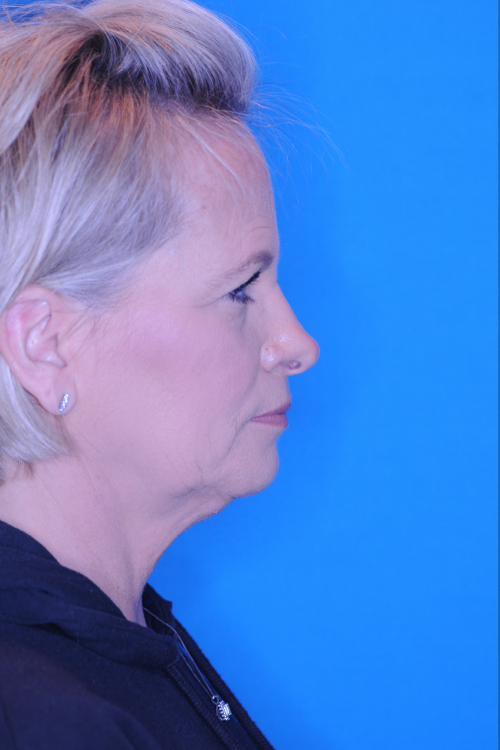 Before Facelift