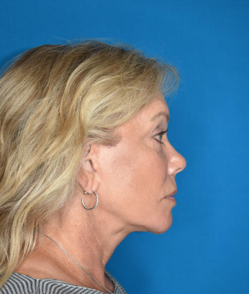 After Facelift