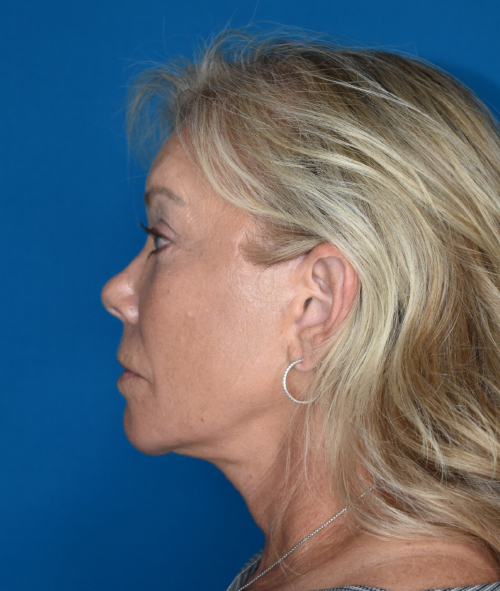 After Facelift