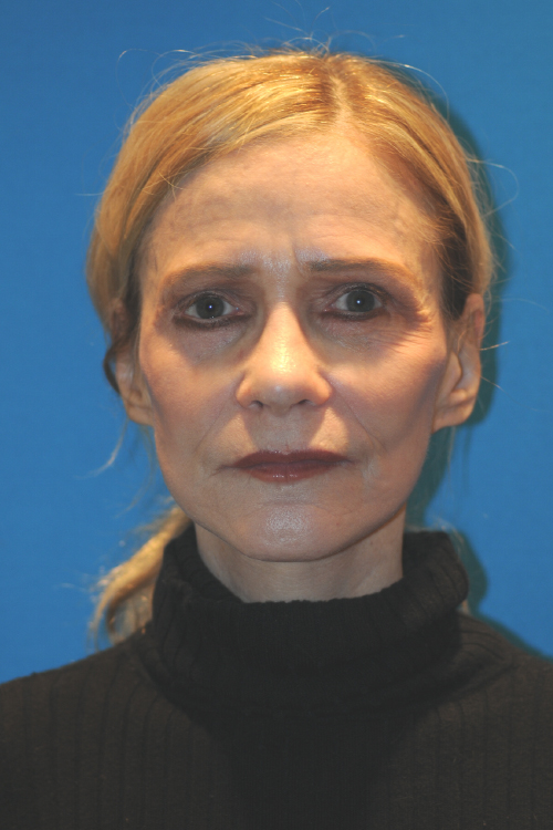 After Facelift