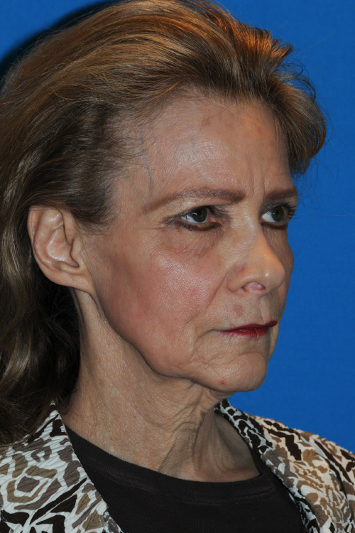 Before Facelift