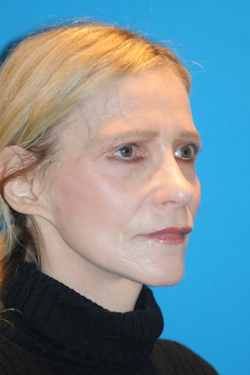 After Facelift