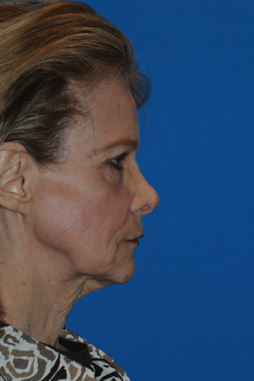 Before Facelift