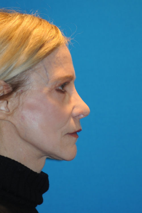 After Facelift